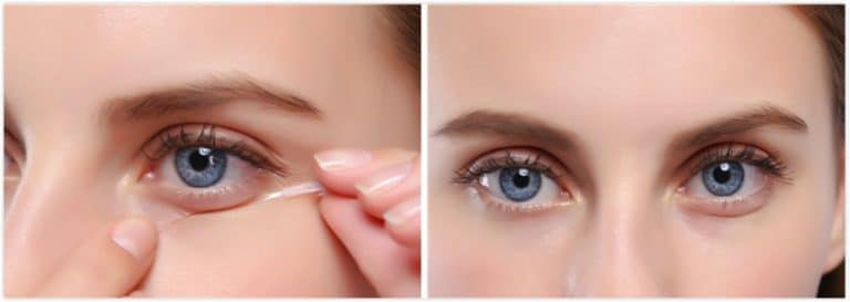 Aegyo sal surgery: cute Korean puffy eyes (애교살) - Richard Troy