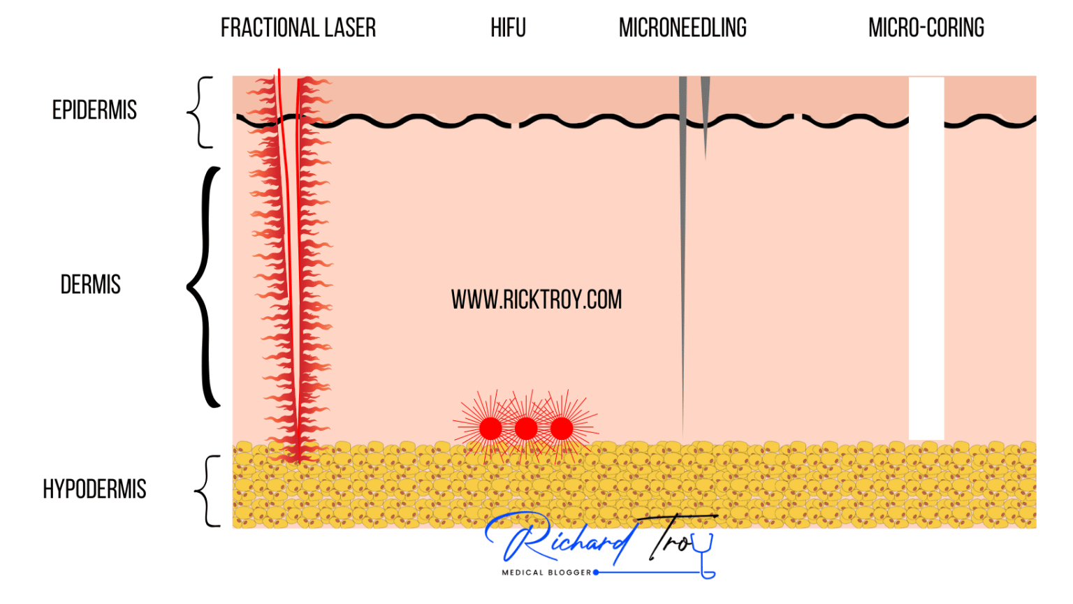 Ellacor dermal microcoring for minimally invasive skin tightening and