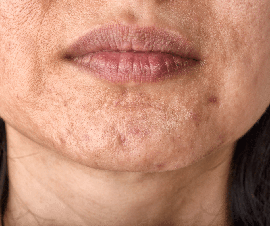How To Make Acne Scars Disappear Overview Of Treatment Options